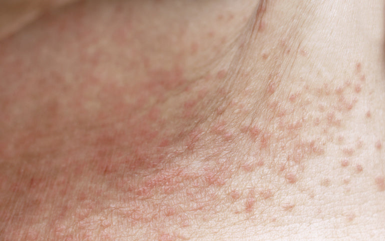 How to Prevent Heat Rash / Prickly Heat